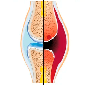 Структурата на здрава и износена става с обозначение на хрущялна тъкан и синовиална течност